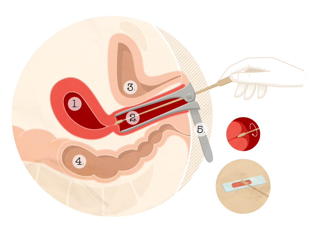 Hpv Et Frottis