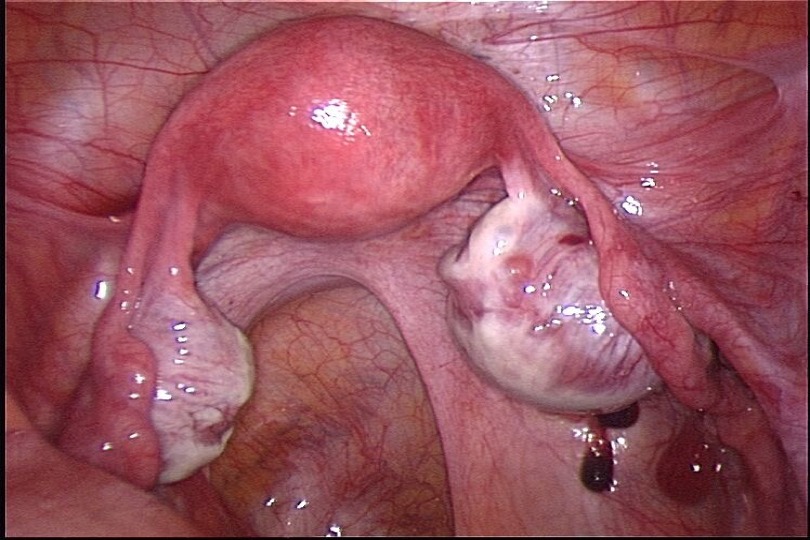 Coelioscopie opératoire: pelvis normal.